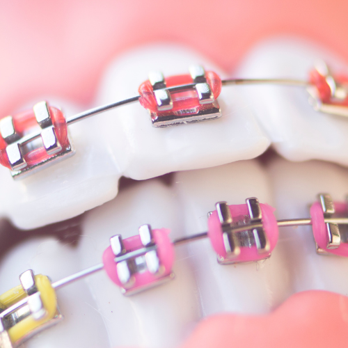 Brackets metálicos convencionales en Barcelona